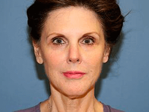 Facelift Before & After