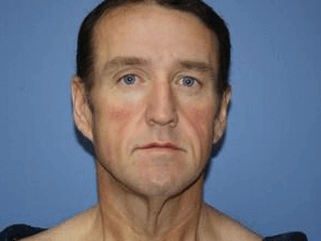 Facelift Before & After