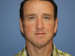 Facelift Before & After