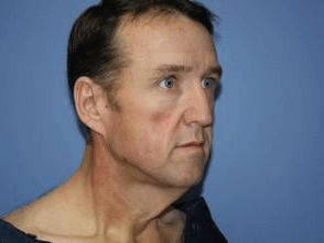 Facelift Before & After