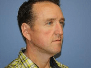 Facelift Before & After