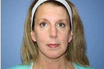 Facelift Before & After