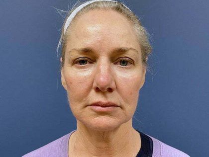Facelift Before & After