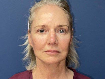 Facelift Before & After