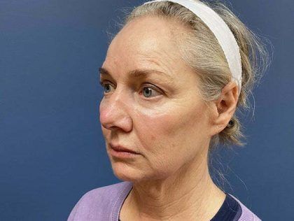 Facelift Before & After