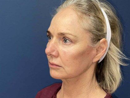 Facelift Before & After