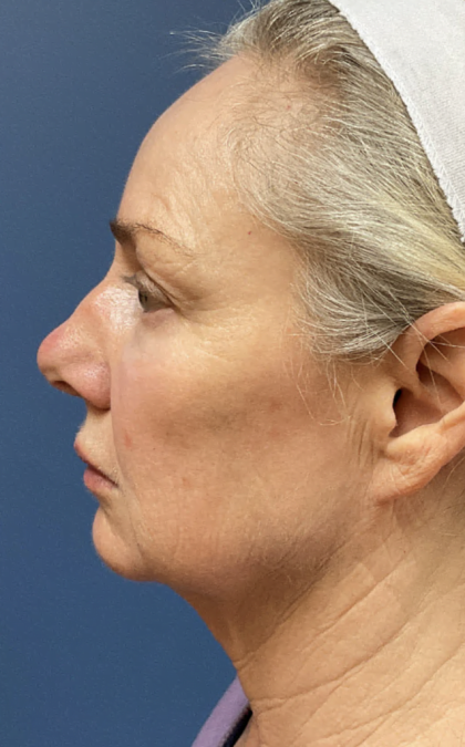 Facelift Before & After