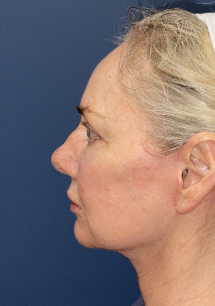Facelift Before & After