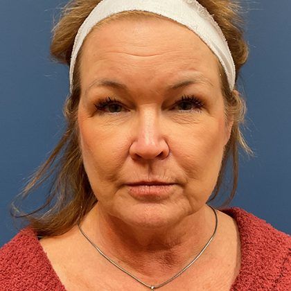 Facelift Before & After