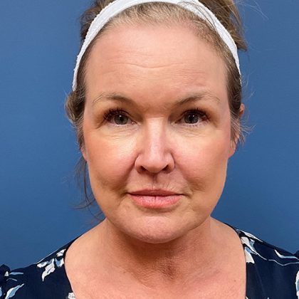 Facelift Before & After