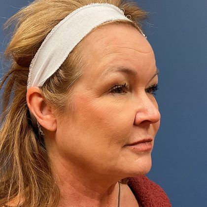 Facelift Before & After