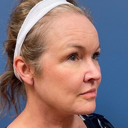 Facelift Before & After