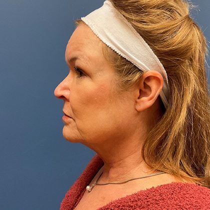 Facelift Before & After