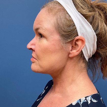 Facelift Before & After