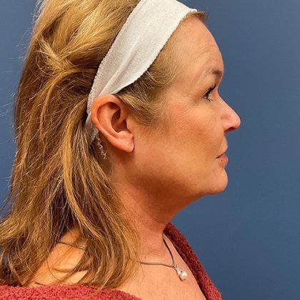 Facelift Before & After