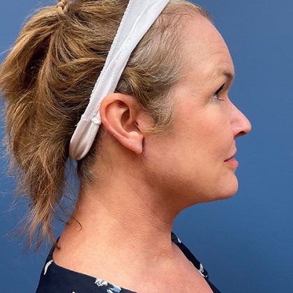 Facelift Before & After