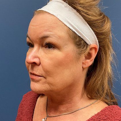 Facelift Before & After