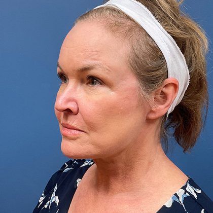 Facelift Before & After