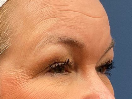 Facelift Before & After