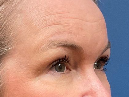 Facelift Before & After