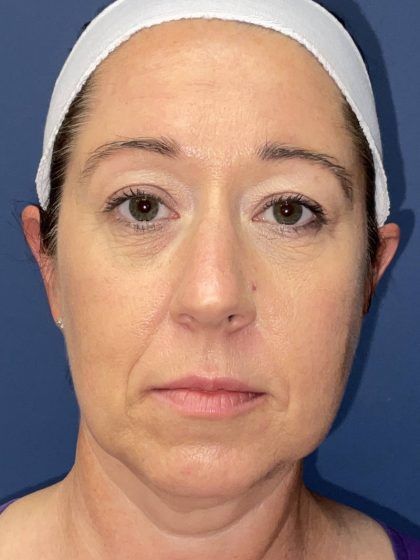 Facelift Before & After