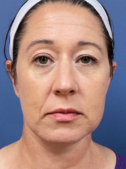 Facelift Before & After