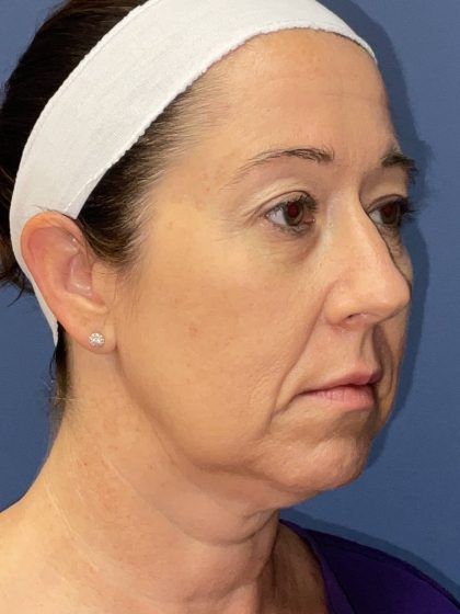 Facelift Before & After