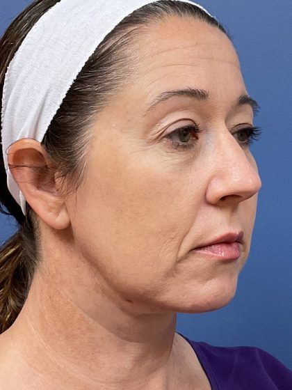 Facelift Before & After