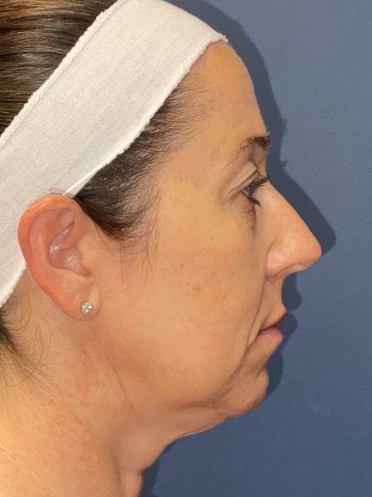 Facelift Before & After