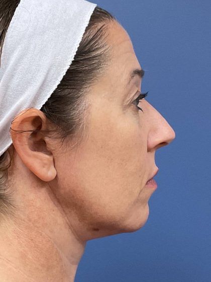 Facelift Before & After