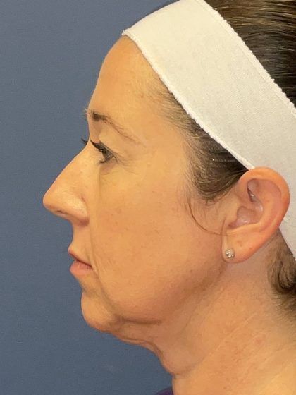 Facelift Before & After