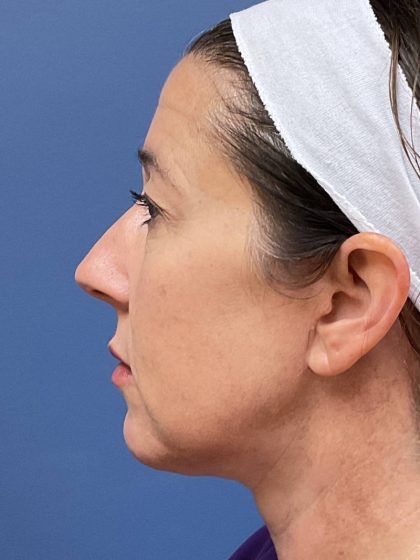 Facelift Before & After