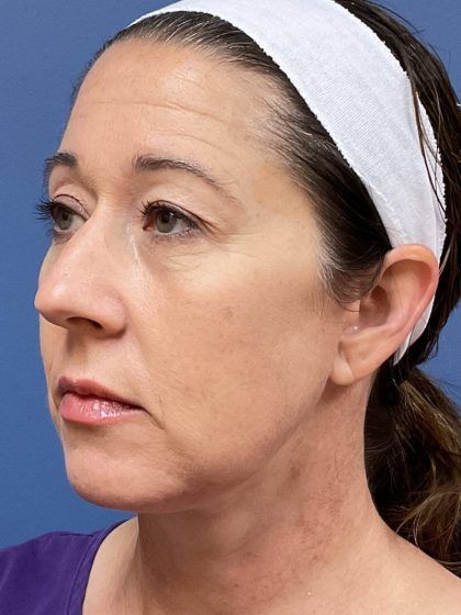 Facelift Before & After