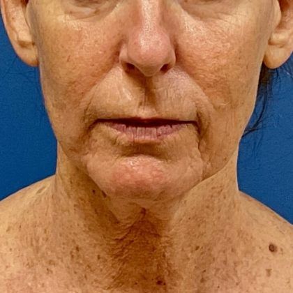 Facelift Before & After