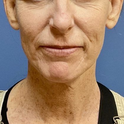 Facelift Before & After