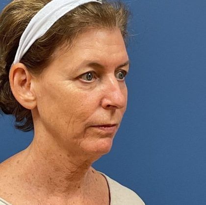 Facelift Before & After