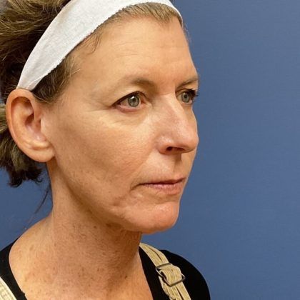 Facelift Before & After