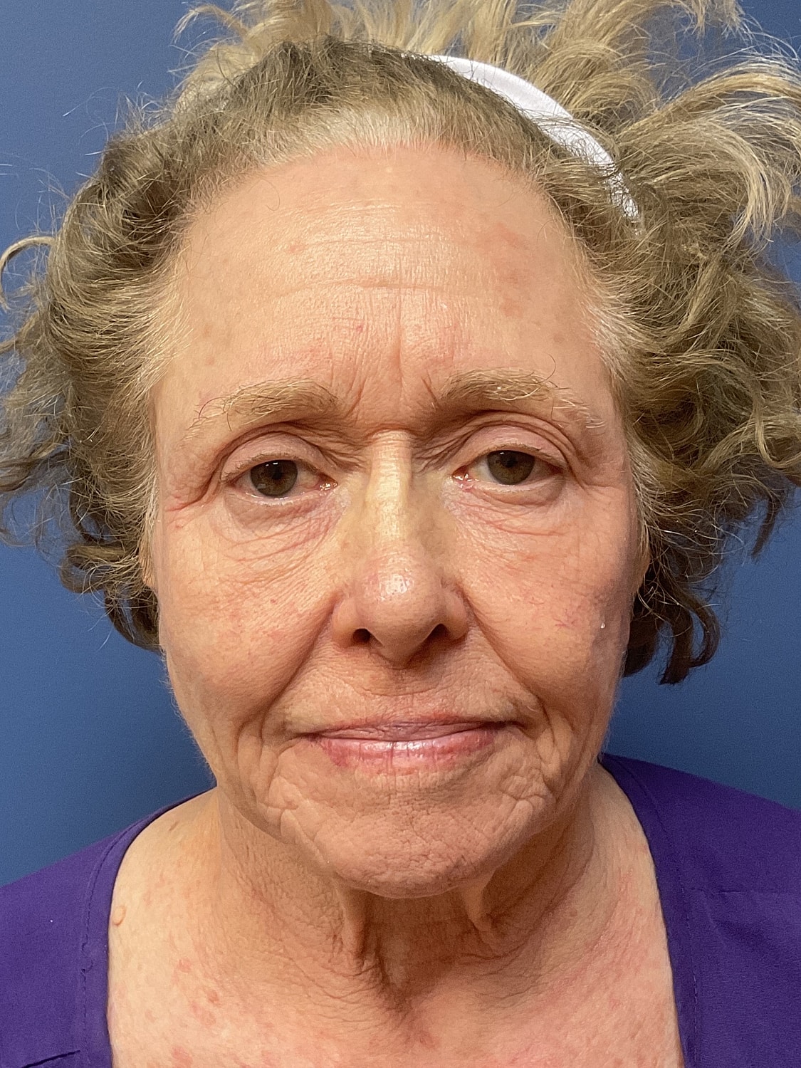 Facelift Before & After