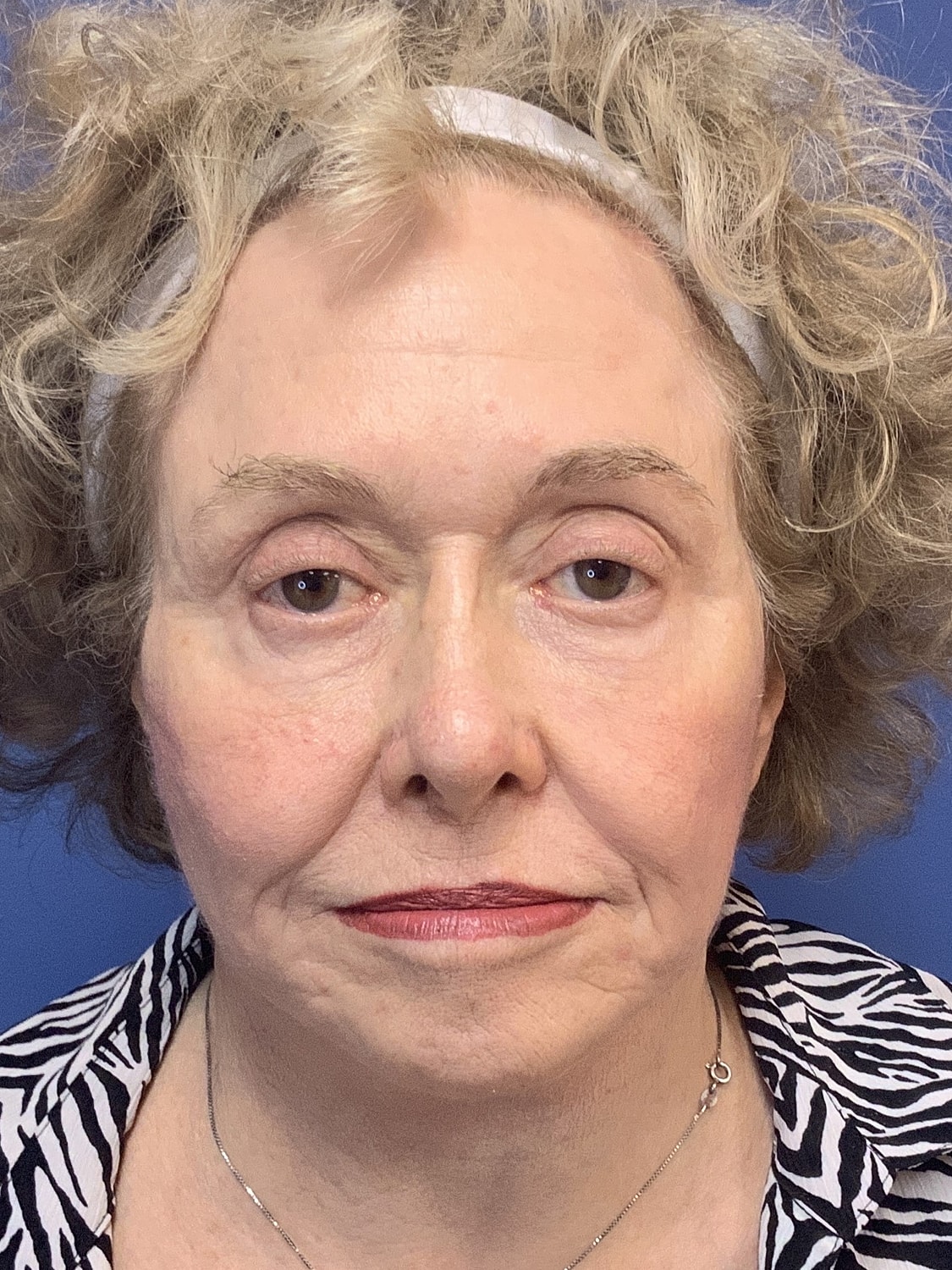 Facelift Before & After
