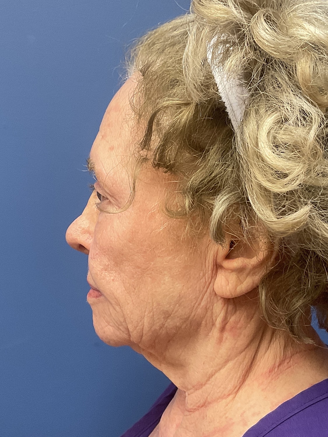 Facelift Before & After