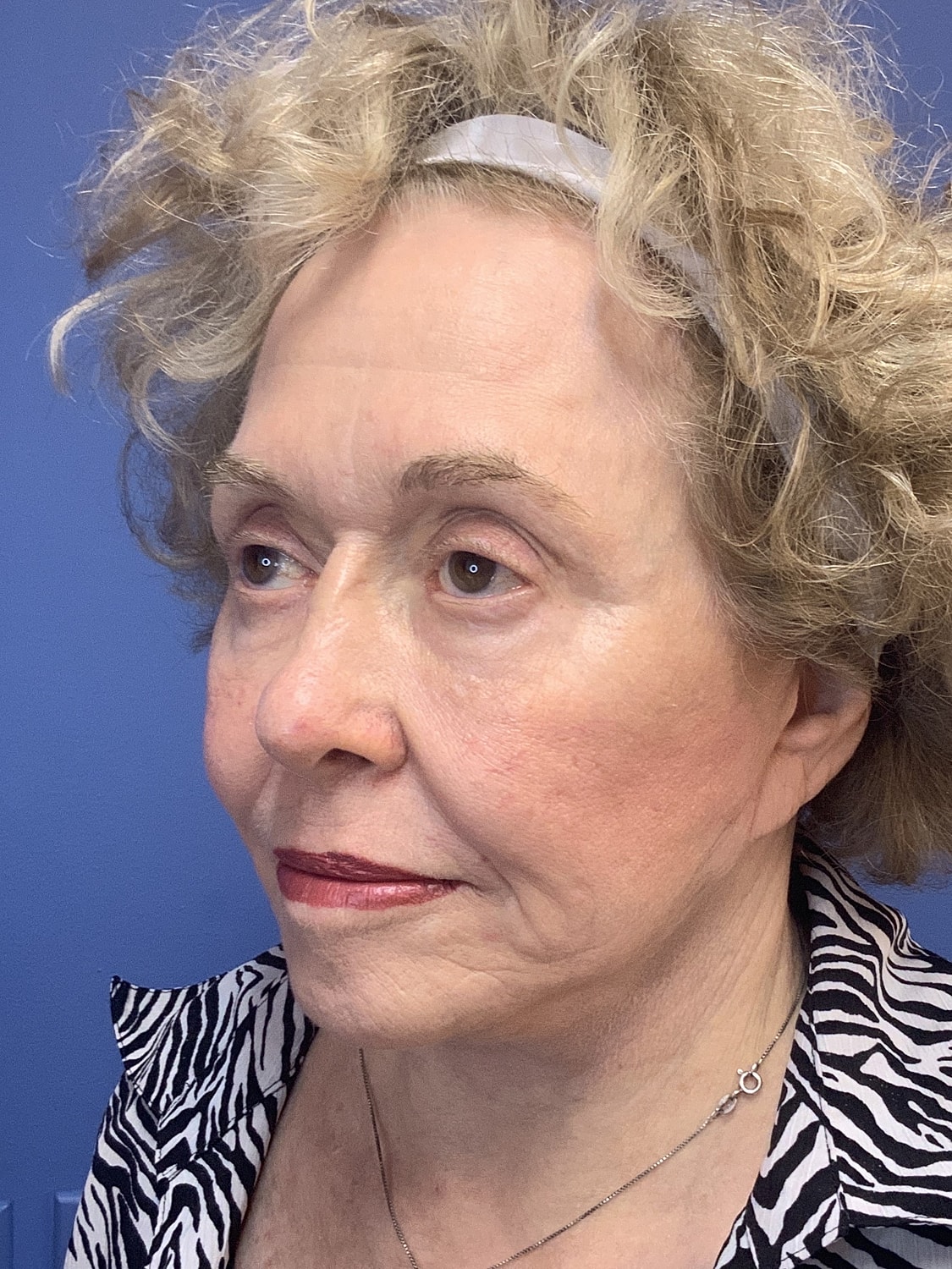 Facelift Before & After