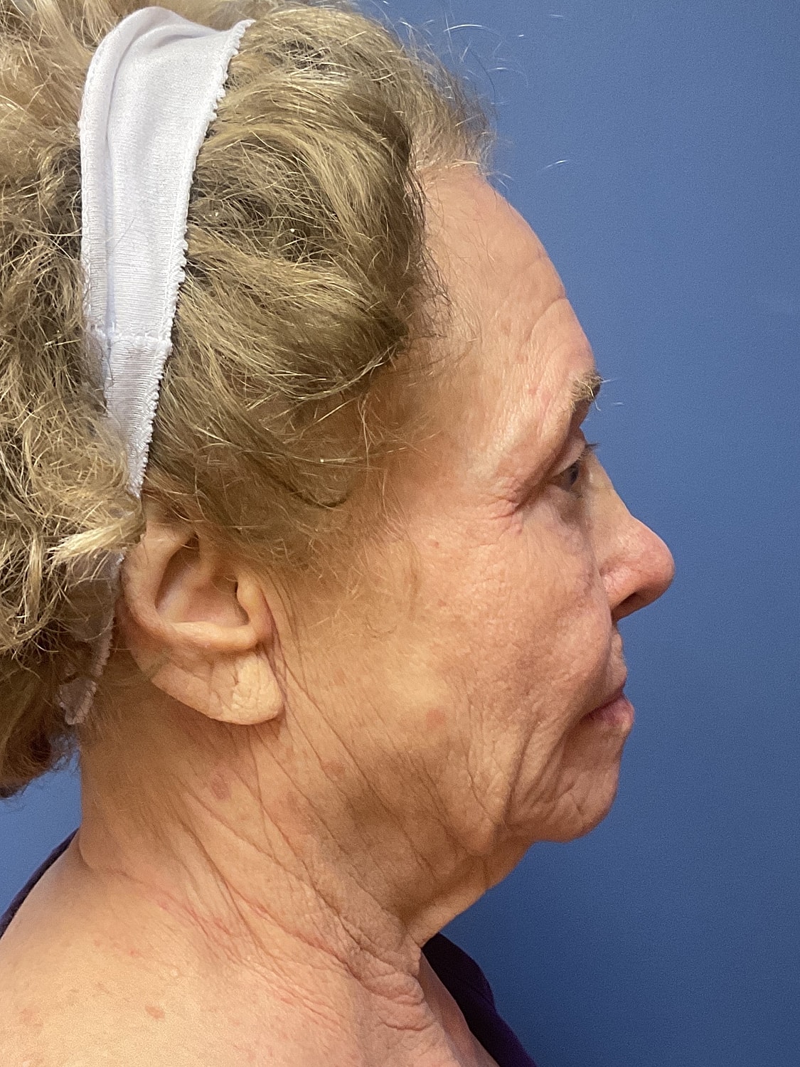 Facelift Before & After