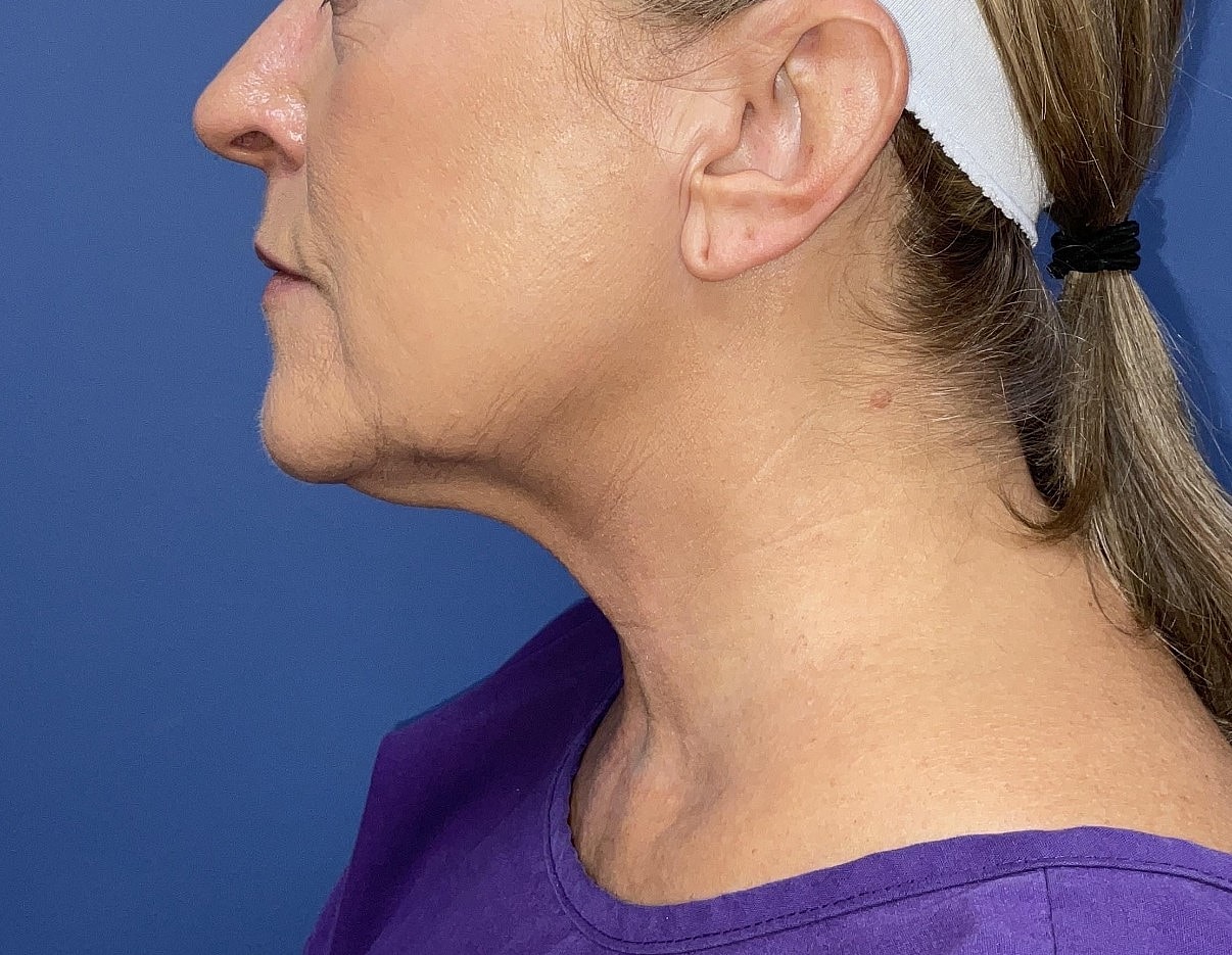 Facelift Before & After