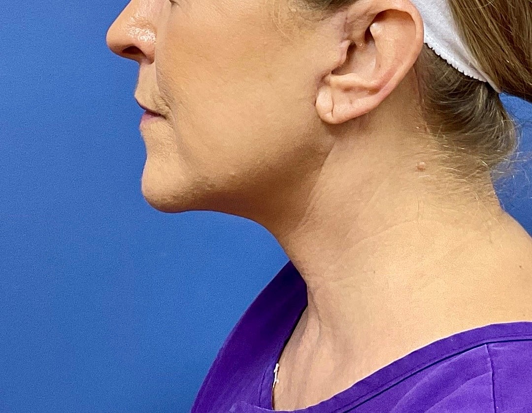 Facelift Before & After