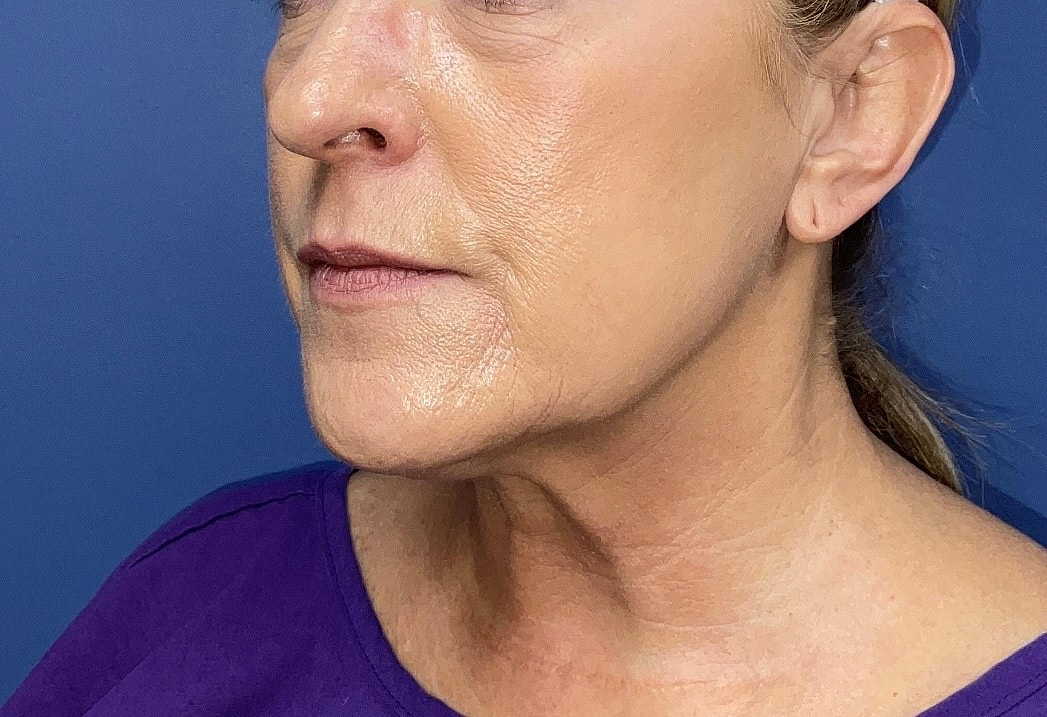 Facelift Before & After