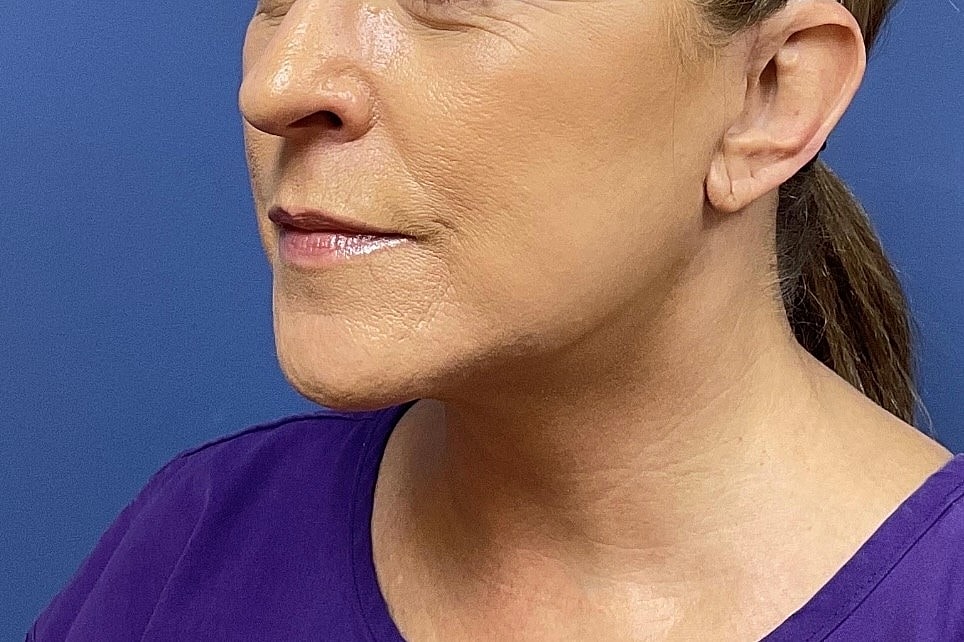 Facelift Before & After