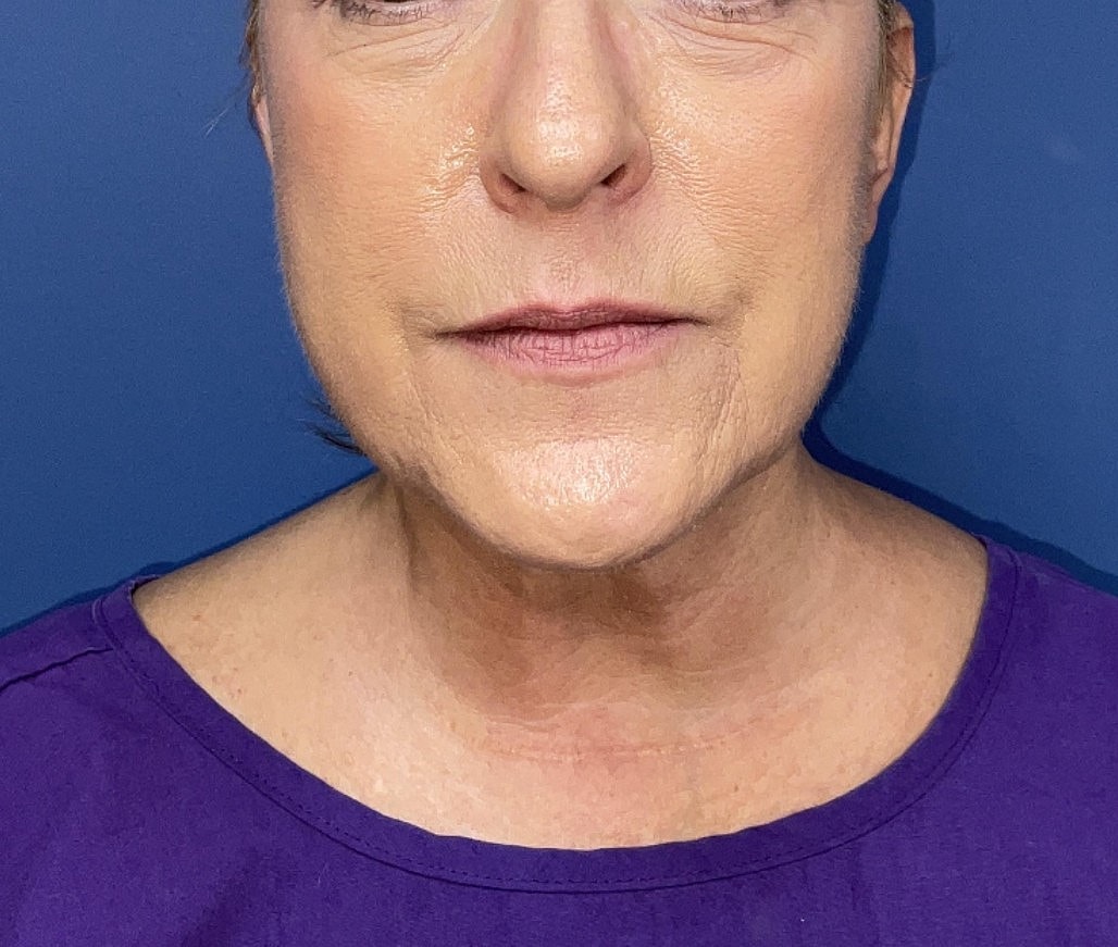 Facelift Before & After