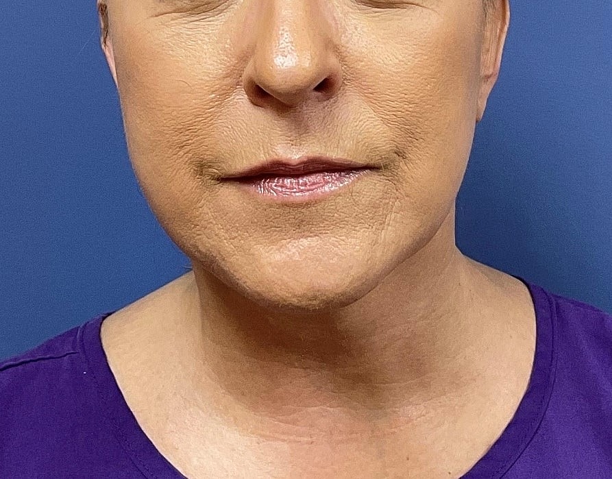 Facelift Before & After