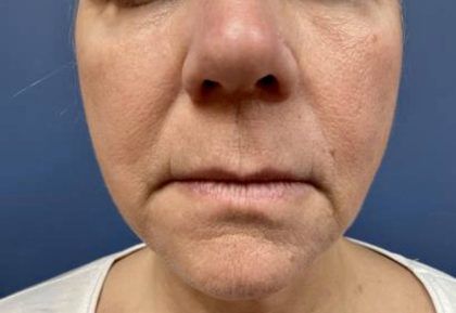 Lip Lift Before & After