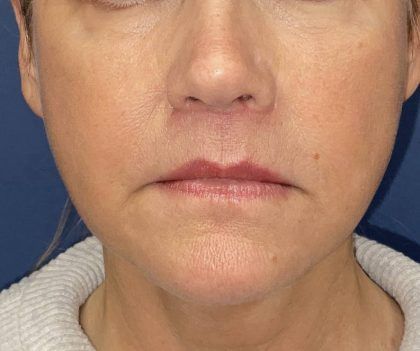 Lip Lift Before & After